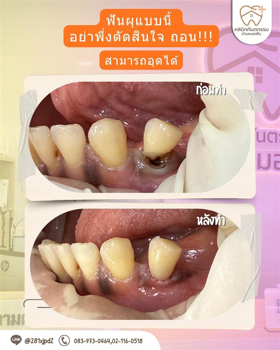 รีวิวฟันผุก่อนและหลังการฟื้นฟู
