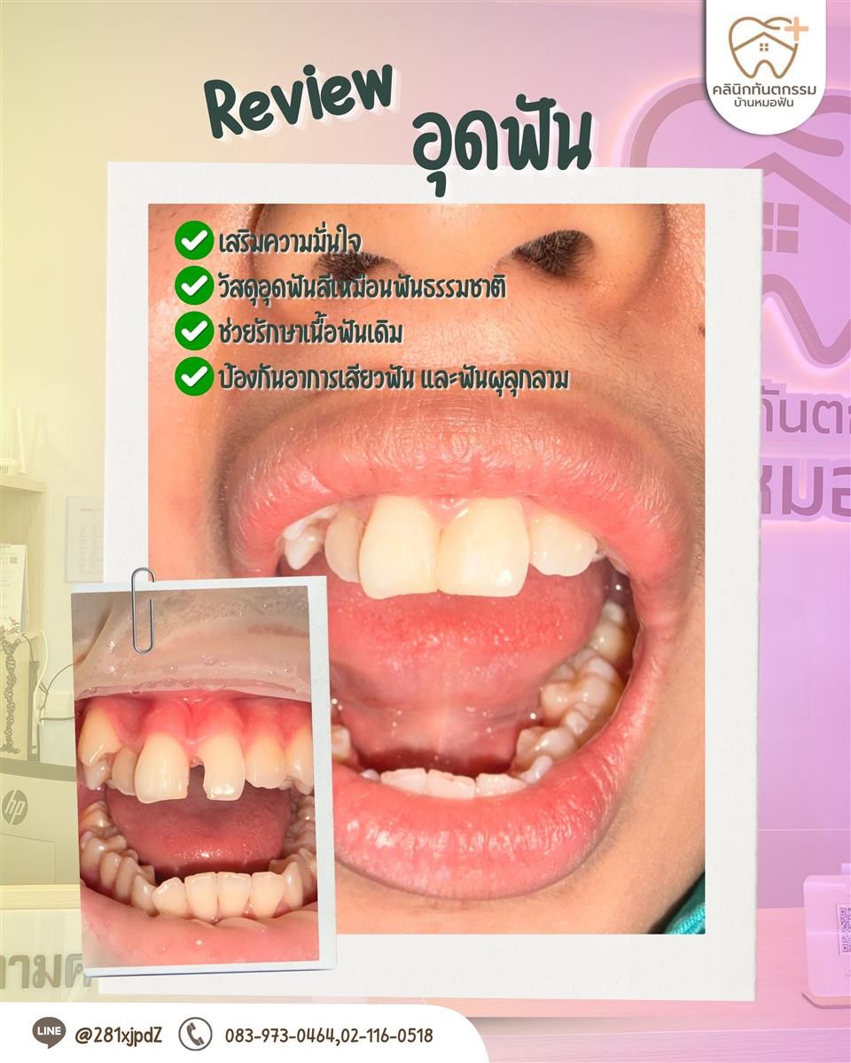 รีวิวอุดฟันหลังรักษาฟันผุ