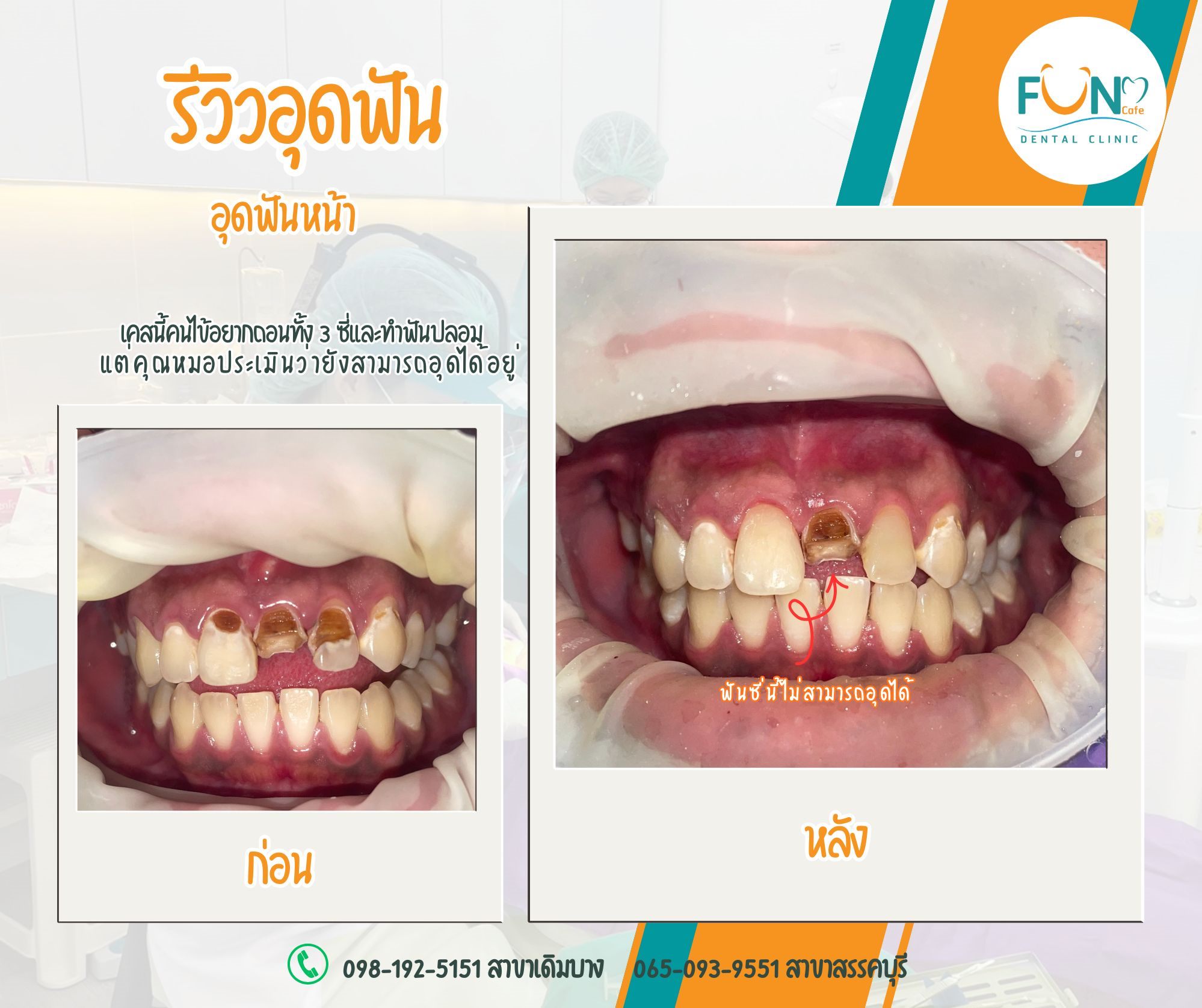 รีวิวอุดฟันหน้าก่อนและหลัง