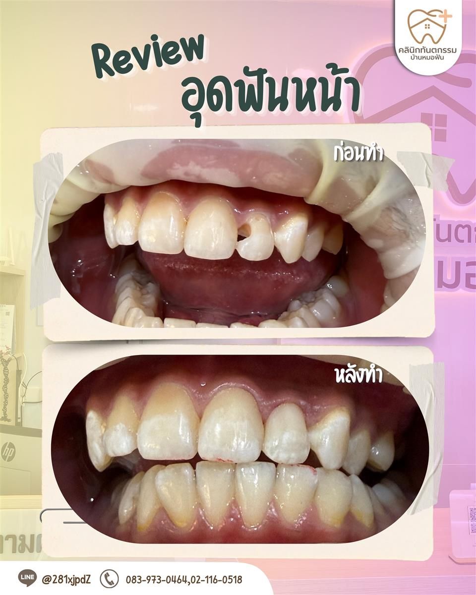 รีวิวอุดฟันหน้าให้รูปทรงฟันดูเรียบร้อยขึ้น