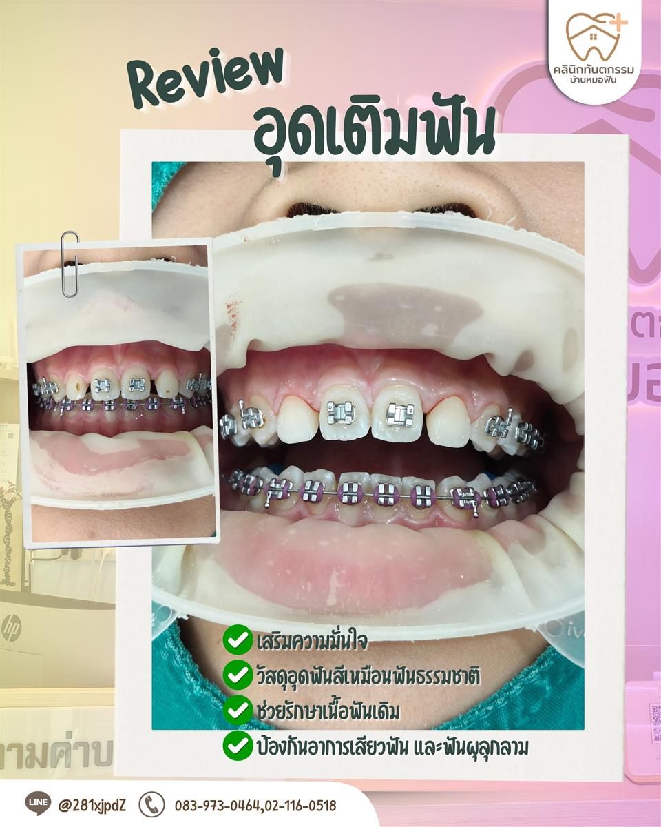 รีวิวอุดเติมฟันระหว่างจัดฟัน